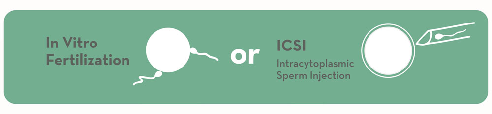 In Vitro Fertilization or ICSI